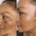 Effective Strategies for Treating Hyperpigmentation and Dark Spots in Skincare