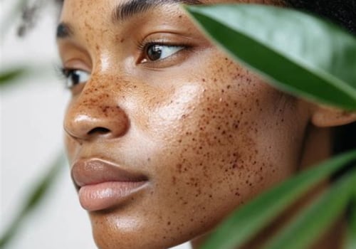 Effective Strategies for Treating and Preventing Hyperpigmentation in Skincare