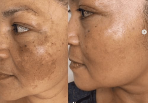 Effective Strategies for Treating Hyperpigmentation and Dark Spots in Skincare