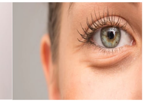 Effective Strategies to Reduce Dark Circles and Puffiness Under Your Eyes